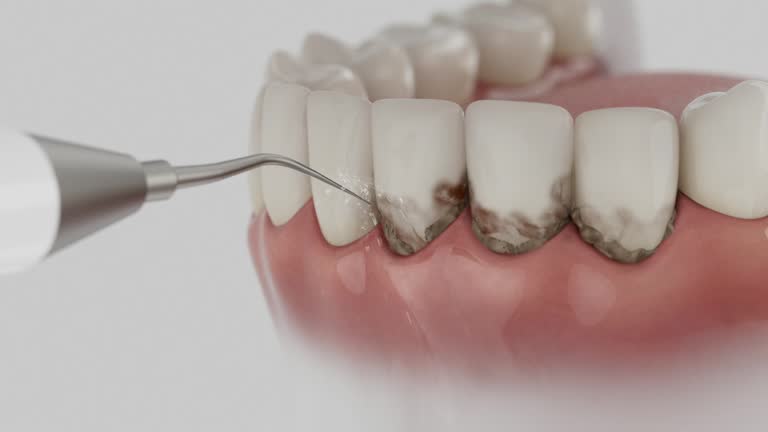 Trusted Wisdom Tooth Removal service in Cambridge, OH - Dentist Open Now
